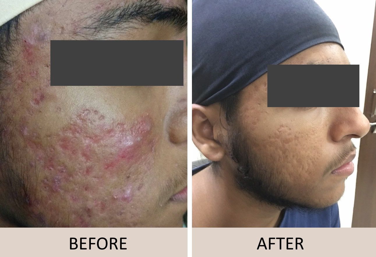 Acne | M A Skin & Hair Superspeciality Clinic - Dr. Manoj Agarwala | Raipur  Chhattisgarh