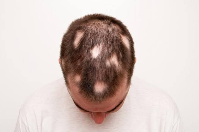 Alopecia Areata