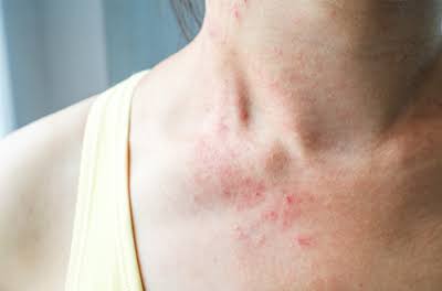 Atopic Dermatitis