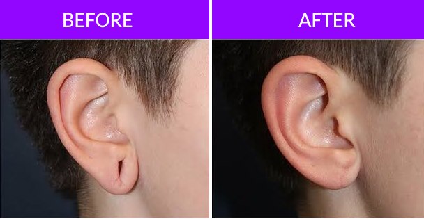 Ear Lobe Repair Surgery