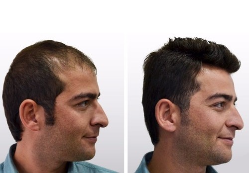 Best Hair Transplant Clinic in India  Hair Transplant Cost  New Roots Hair  Clinic