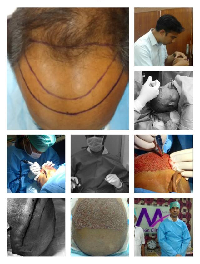 Hair Transplantation