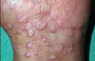 Lichen Planus