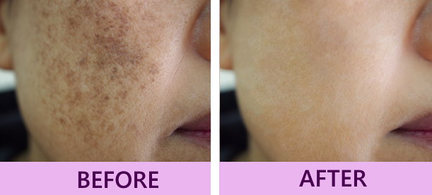 Melasma