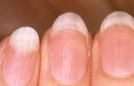 Nail Diseases