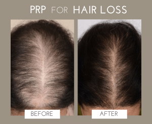 PRP Therapy | M A Skin & Hair Superspeciality Clinic - Dr. Manoj Agarwala |  Raipur Chhattisgarh