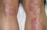 Psoriasis