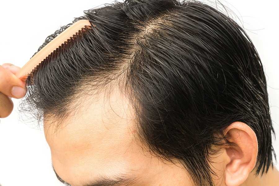 Regenera Activa Treatment | M A Skin & Hair Superspeciality Clinic - Dr.  Manoj Agarwala | Raipur Chhattisgarh