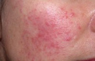 Rosacea