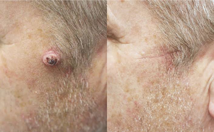 Skin Cancer Excision