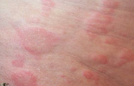 Urticaria