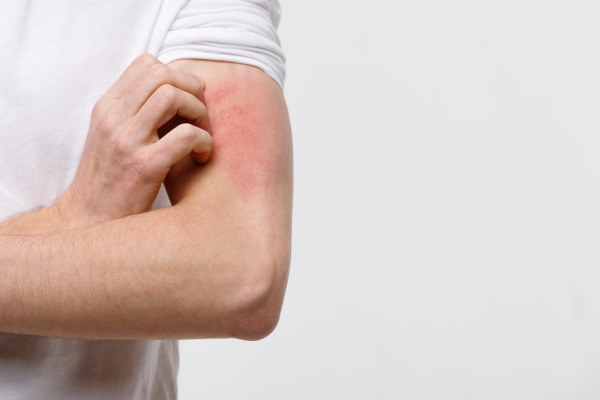 Urticaria Hives