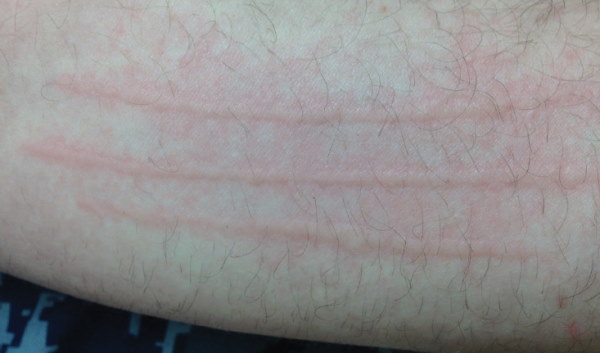 Urticaria Hives